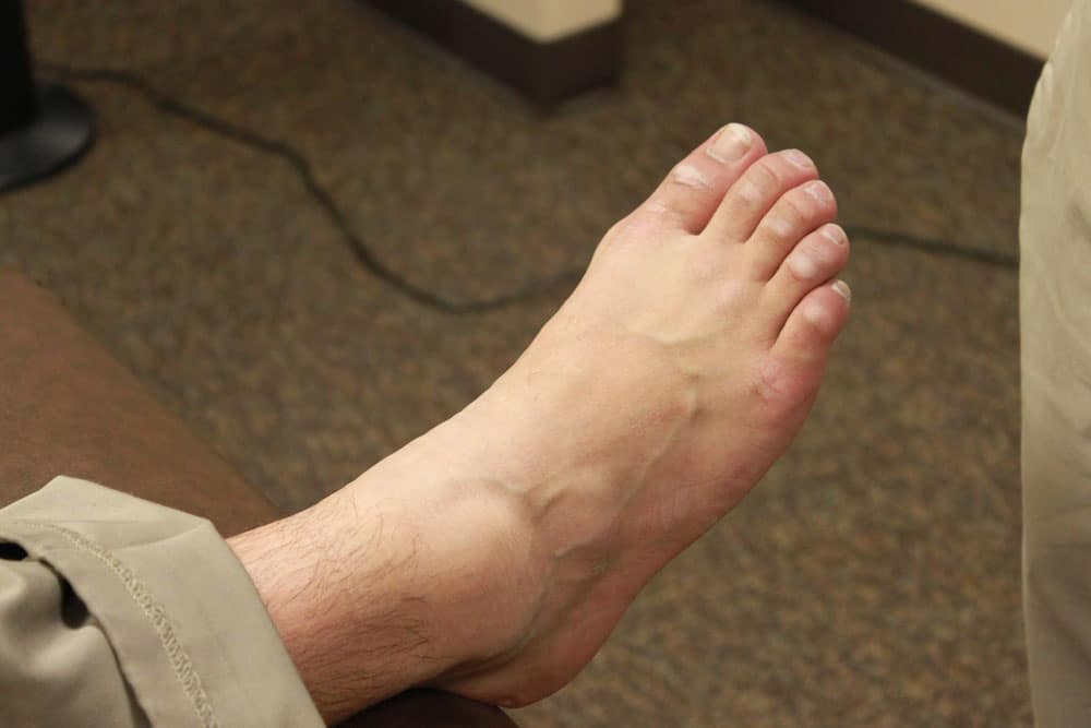 Plantar Fasciitis / Foot Pain - News & Info - Abingdon Therapy