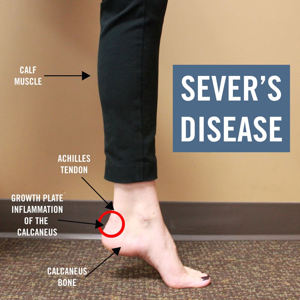 Heel cups clearance sever's disease