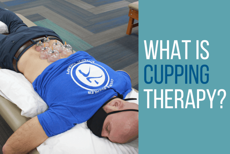 What Is Cupping Therapy (Myofascial Decompression)?